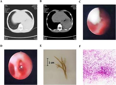 Risk factors for pleural effusion in children with plastic bronchitis caused by pneumonia